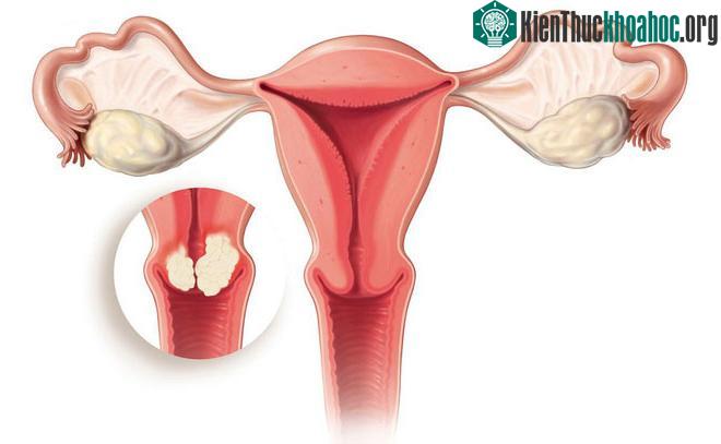 Ung thư cổ tử cung là một trong những căn bệnh ung thư phổ biến nhất ở phụ nữ trên thế giới.