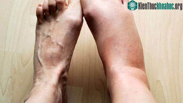 Sự dồn đến của các chất lỏng và các chất khác đến chỗ bị thương chính là nguyên nhân tạo ra sưng.