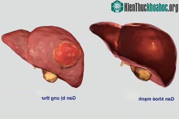 Hình ảnh so sánh giữa lá gan khoẻ mạnh và gan bị ung thư.