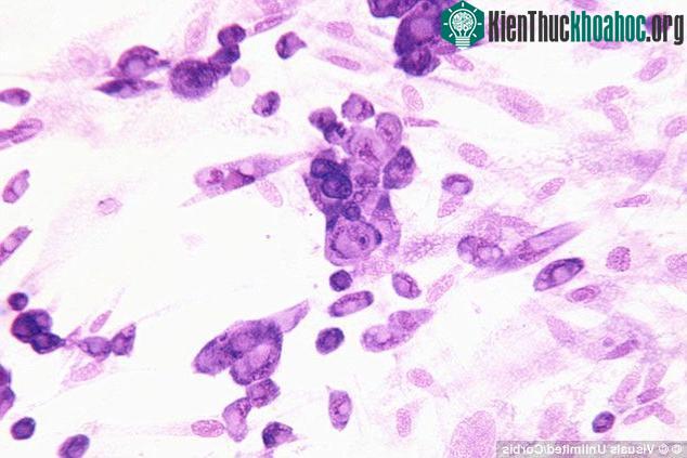 Virus herpes.