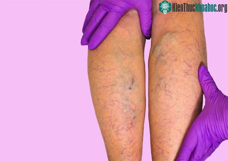 Bạn có thể phòng ngừa suy giãn tĩnh mạch chi dưới bằng cách cải thiện các hoạt động hàng ngày.