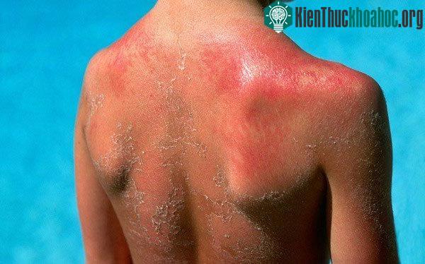 Cháy nắng là tình trạng khi phơi mình quá lâu dưới ánh nắng, làn da chúng ta sẽ có biểu hiện đỏ ửng.