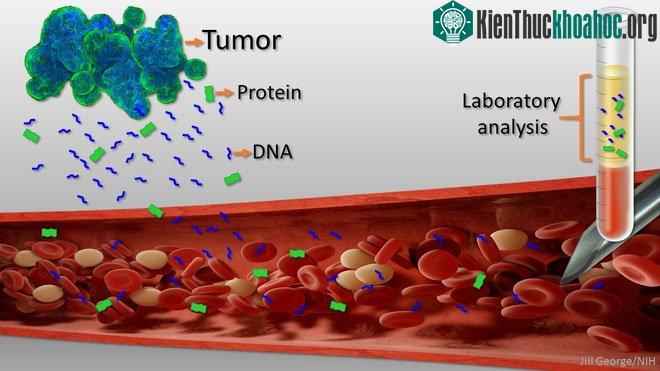 Ung thư giải phóng các DNA và protein vào máu trước cả khi các triệu chứng xuất hiện.