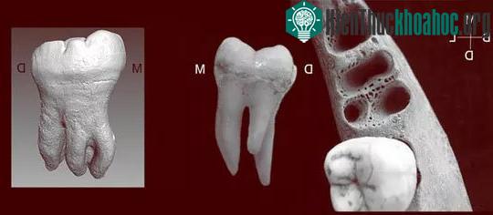 Chiếc răng kỳ dị 3 chân