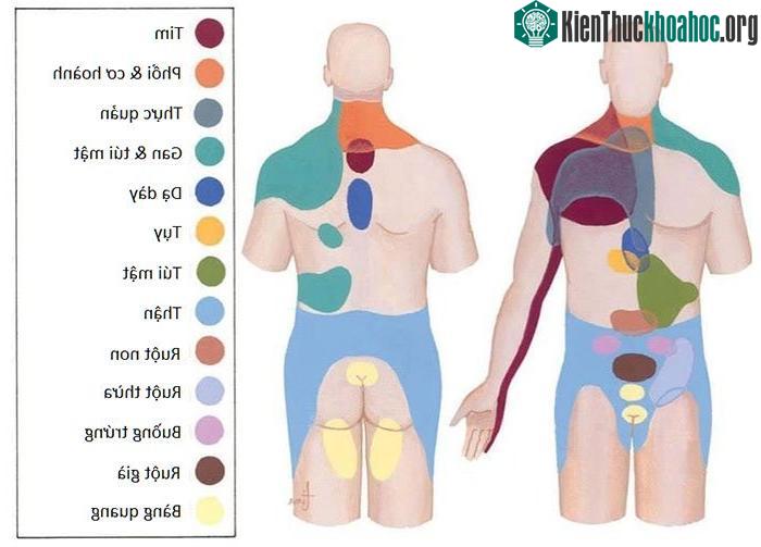 Bản đồ phác họa liên hệ giữa vùng da bị đau với bộ phận bị tổn thương.