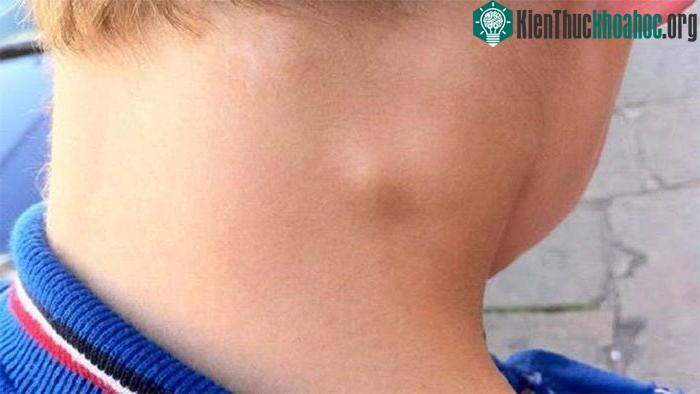 Nổi hạch ở cổ bên phải cảnh báo bệnh gì, có nguy hiểm không? ảnh 0