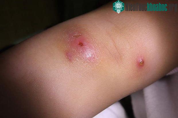 Thâm da do bị viêm hoặc chảy mủ là dấu hiệu nhiễm trùng tụ cầu khuẩn cơ bản nhất.