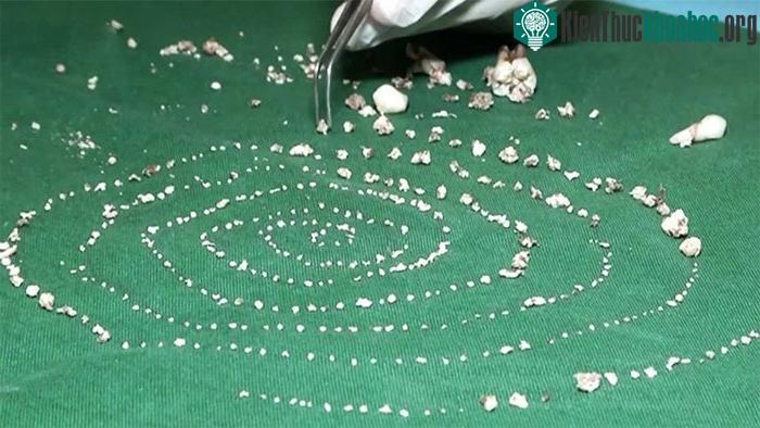 Số răng các bác sĩ đã lấy ra được từ miệng cậu bé.