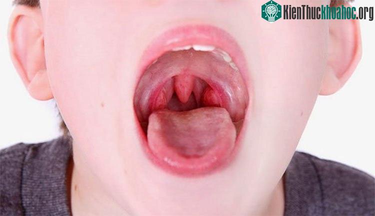 Viêm họng hạt