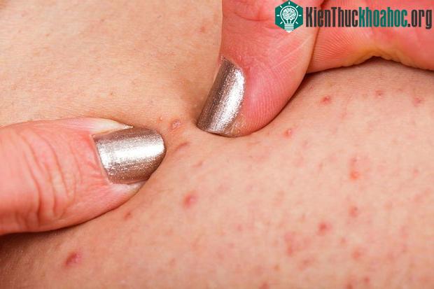 Lúc thời tiết nóng, mồ hôi tiết ra nhiều, nếu vệ sinh cơ thể không kịp thời, nang lông sẽ bị chặn và gây viêm.