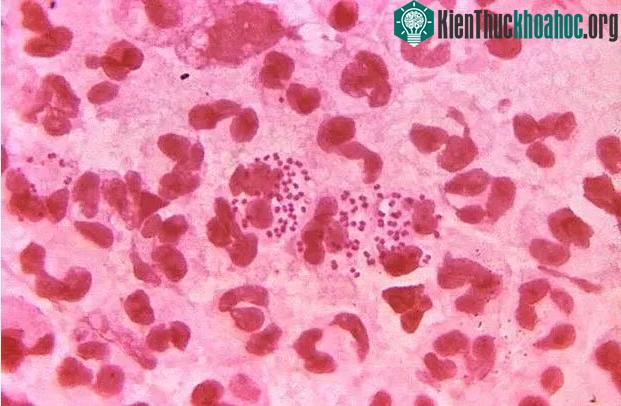 Cảnh báo 1 dạng biến chứng bệnh tình dục tấn công lên não ảnh 0