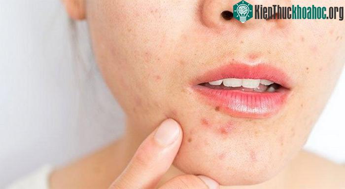 Mụn trứng cá là tình trạng da phổ biến nhất ở nhiều quốc gia trên thế giới.