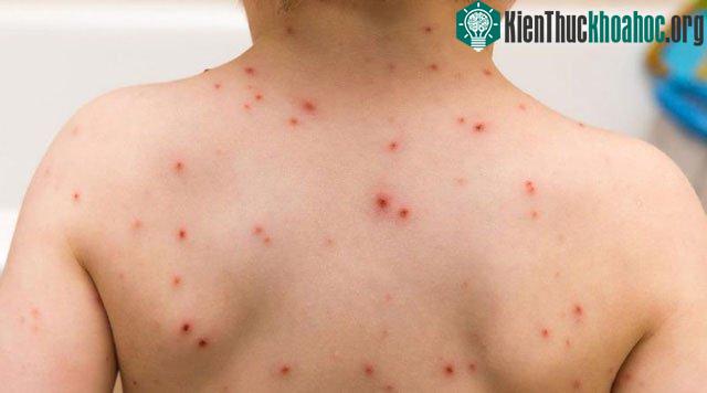 Bệnh thủy đậu cũng là một dạng vũ khí sinh học.