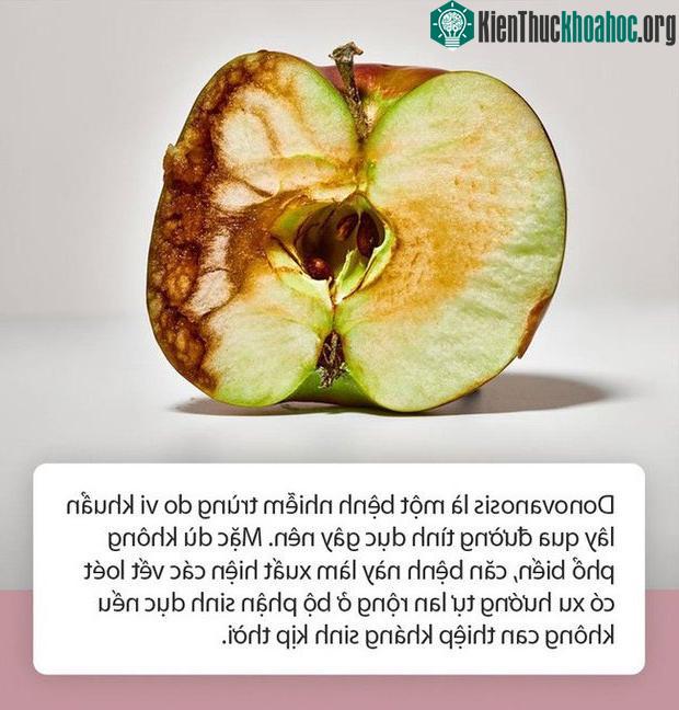 Những điều cần biết về căn bệnh lây truyền qua đường tình dục có thể "ăn thịt người" ảnh 0