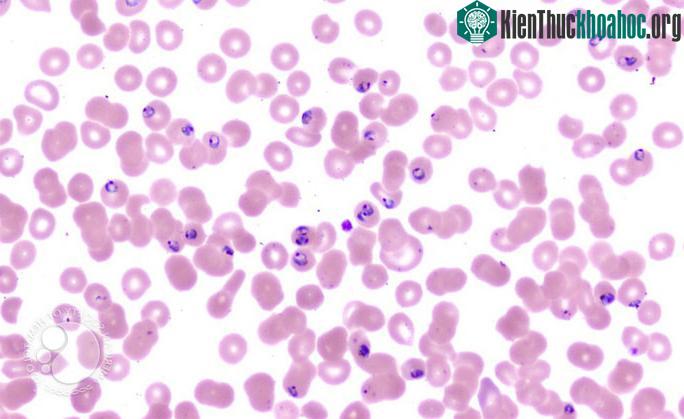 Plasmodium falciparum, "quái vật" nhỏ gây nên căn bệnh sốt rét chết người