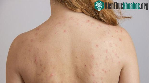 Khi bị rối loạn nội tiết, cơ thể sẽ sản sinh ra nhiều mụn, đặc biệt mụn ở mặt và lưng.
