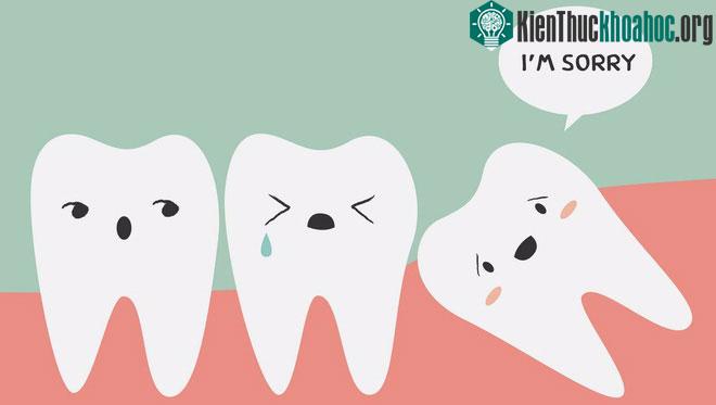 Những chiếc răng khôn thường mọc ngầm, bị lệch lạc vì thiếu chỗ.