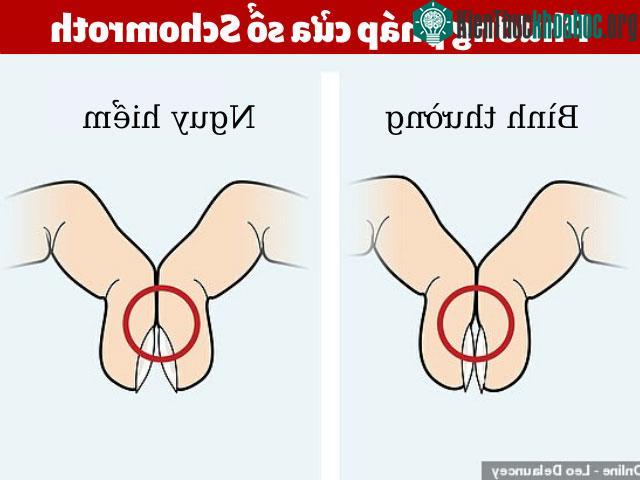 Cách thực hiện phương pháp "Cửa sổ Schamroth".