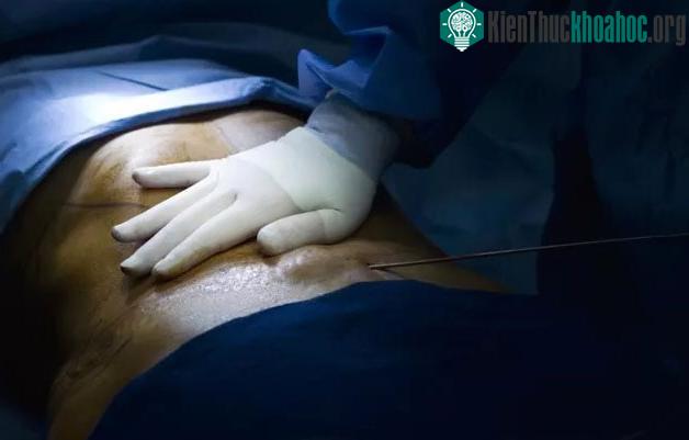 Nhiễm trùng có thể xảy ra sau mọi loại phẫu thuật và (dĩ nhiên) có thể xảy ra sau khi hút mỡ.