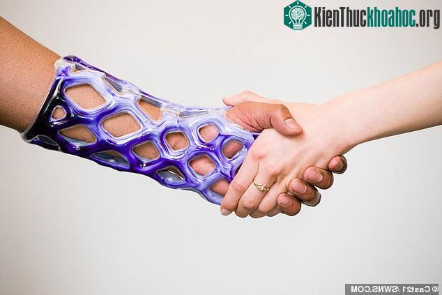 Khuôn bó bột kiểu mới không gây ngứa, không mùi, không cần cắt bằng cưa ảnh 1