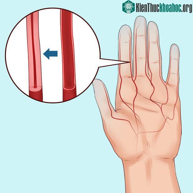 Người mắc phải bệnh Raynaud thường có mạch dễ co lại nhiều hơn.