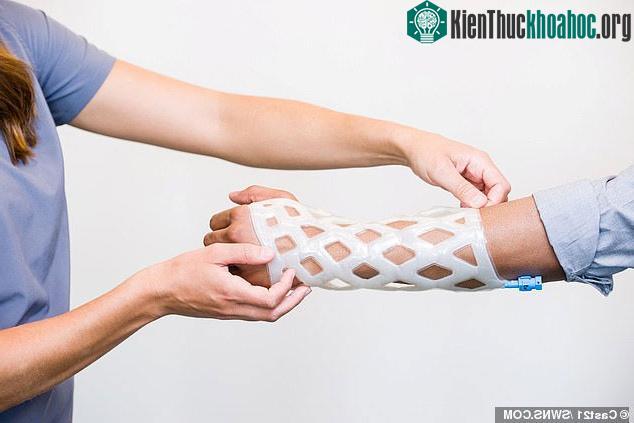 Khuôn bó bột kiểu mới không gây ngứa, không mùi, không cần cắt bằng cưa ảnh 3