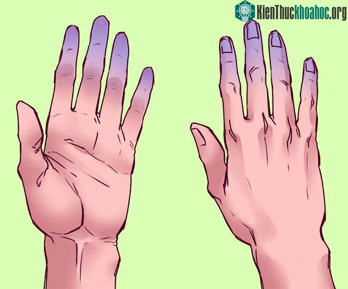 Ngón tay nhợt nhạt, tím tái