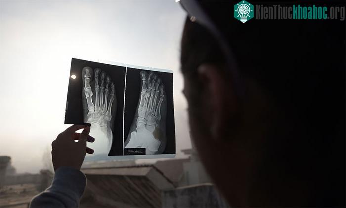 Một bé gái sử dụng tấm giấy chụp x quang như một tấm lọc để quan sát hiện tượng nhật thực.
