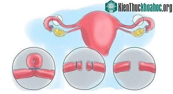 Thắt ống dẫn trứng để trứng không thể di chuyển vào tử cung.