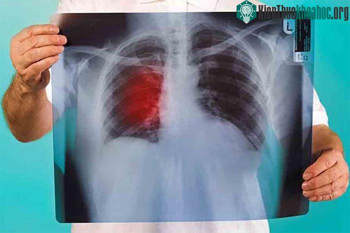 Chữa trị ung thư phổi bằng phương pháp "làm sạch" các khối u từ các cơ quan trong cơ thể ở giai đoạn đầu