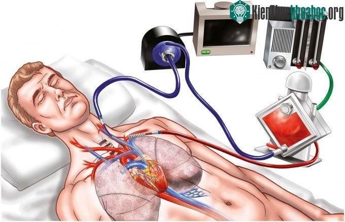 Hình minh họa hoạt động của ECMO