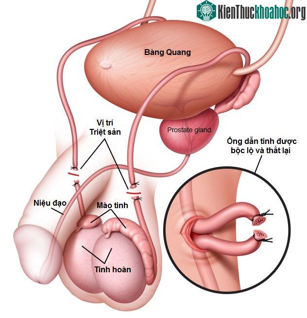 Thắt ống dẫn tinh giúp ngăn tinh trùng phóng ra.