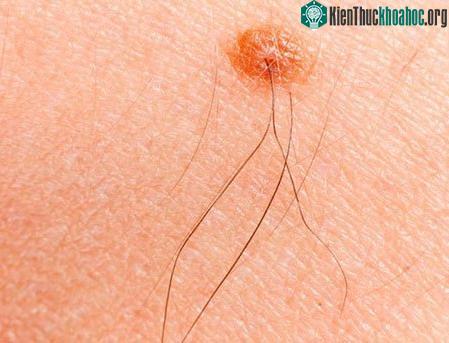 Thực tế, sự có mặt của một sợi lông mọc ở nốt ruồi lại chỉ ra rằng đó là điều bình thường và hoàn toàn vô hại