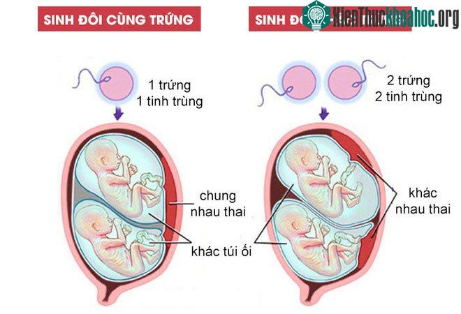 Sự khác nhau giữa sinh đôi cùng trứng và khác trứng