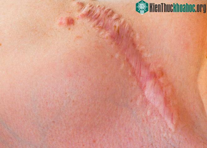 Loại gel này có thể giúp mọi vết thương hở lớn lành lại hoàn toàn mà không để lại sẹo.