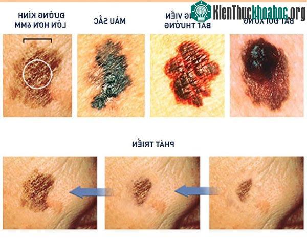 Dấu hiệu của nốt ruồi gây ung thư
