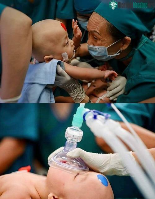 Dấu chấm tròn màu xanh, đỏ được dán trên trán hai bé.