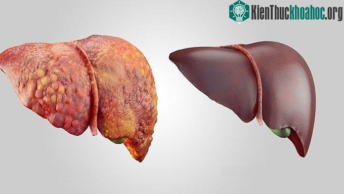Gan là một trong những cơ quan bị ảnh hưởng nghiêm trọng bởi rượu.
