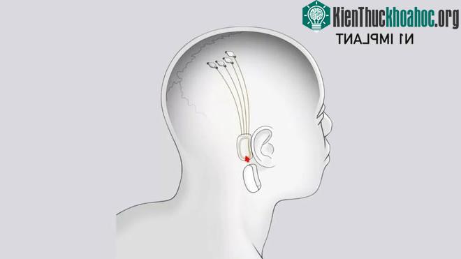 Con chip đặt trong não có thể đem lại cách nghe nhạc hoàn toàn mới.