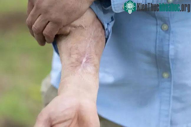 Vết sẹo trên bàn tay anh.
