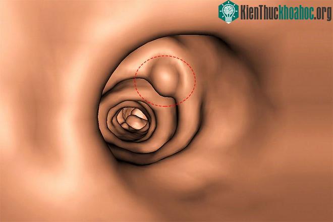 Polyp ruột