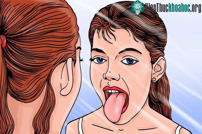 Màu sắc của lưỡi tiết lộ tình trạng của bạn