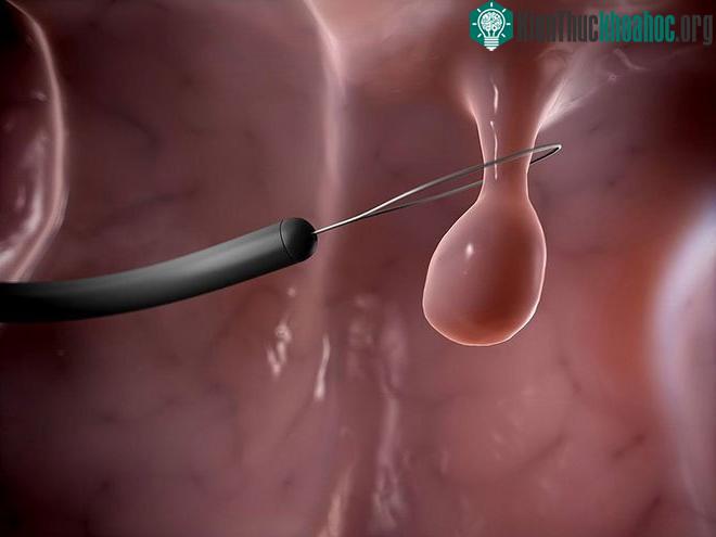 Polyp dạ dày