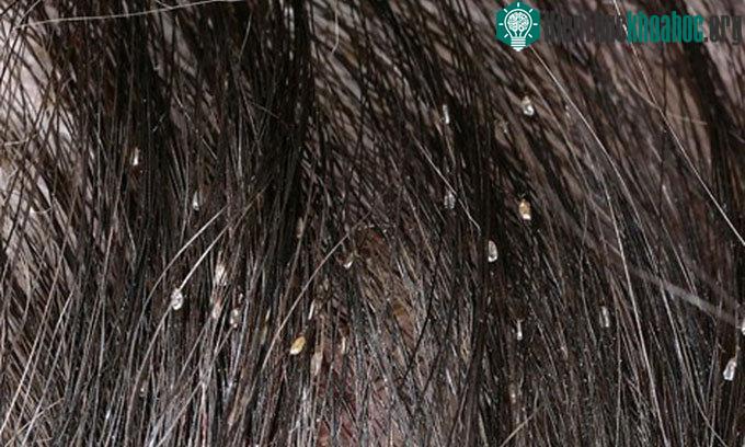 Chấy rận thường ở da đầu, không gây chết người nhưng khó chịu