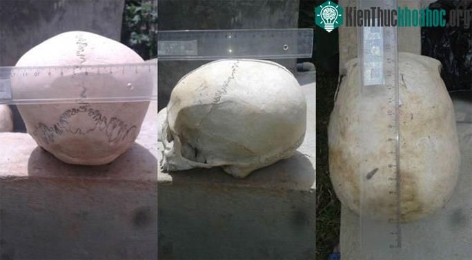 Cận cảnh những hộp sọ bị kéo dài bất thường về phía sau và hơi chếch lên