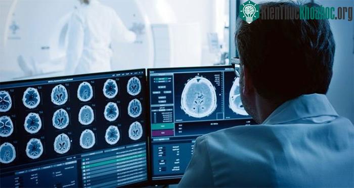 86% bệnh nhân mắc FAS do chấn thương não, đột quỵ.