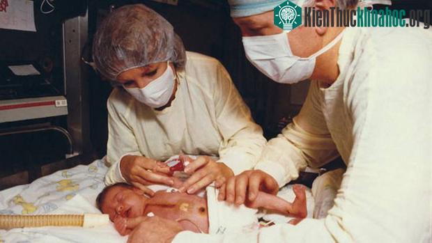 Bé gái sơ sinh sống được 21 ngày sau khi ghép tim khỉ.