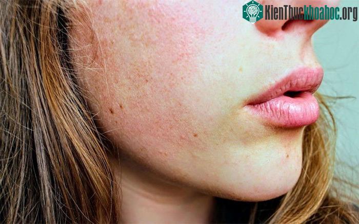 Eczema ảnh hưởng mọi quốc gia, chủng tộc và làn da.