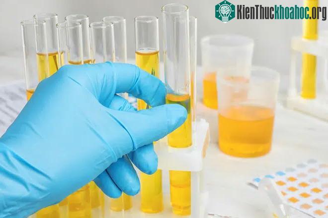 Xét nghiệm nước tiểu