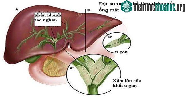 Ung thư ống mật